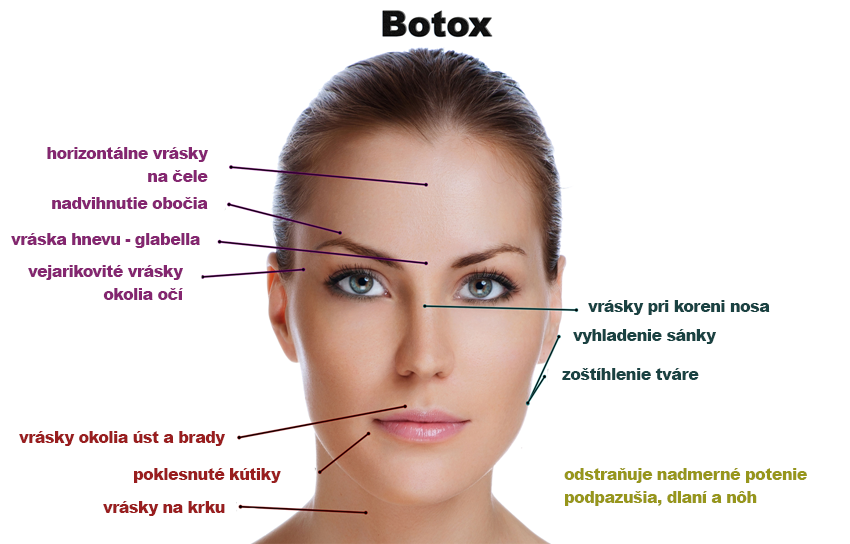botox (2)